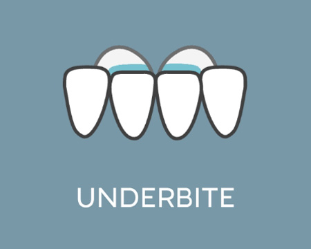 Everette-Underbite